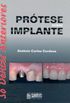 Prtese Sobre Implante: S Dentes Anteriores